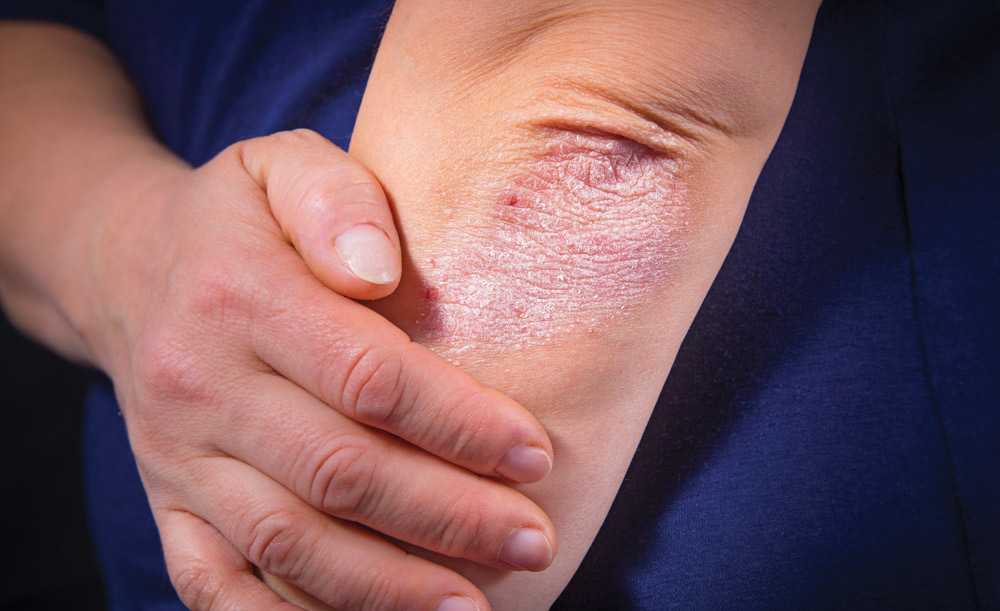 psoriaz n18