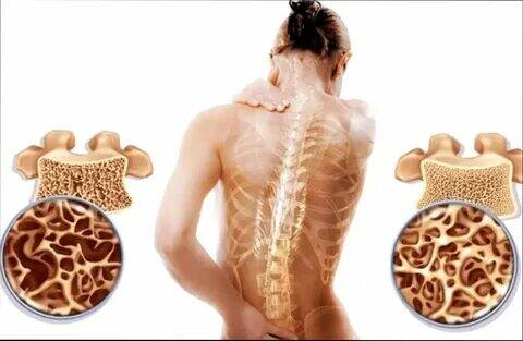 Osteoporoz1